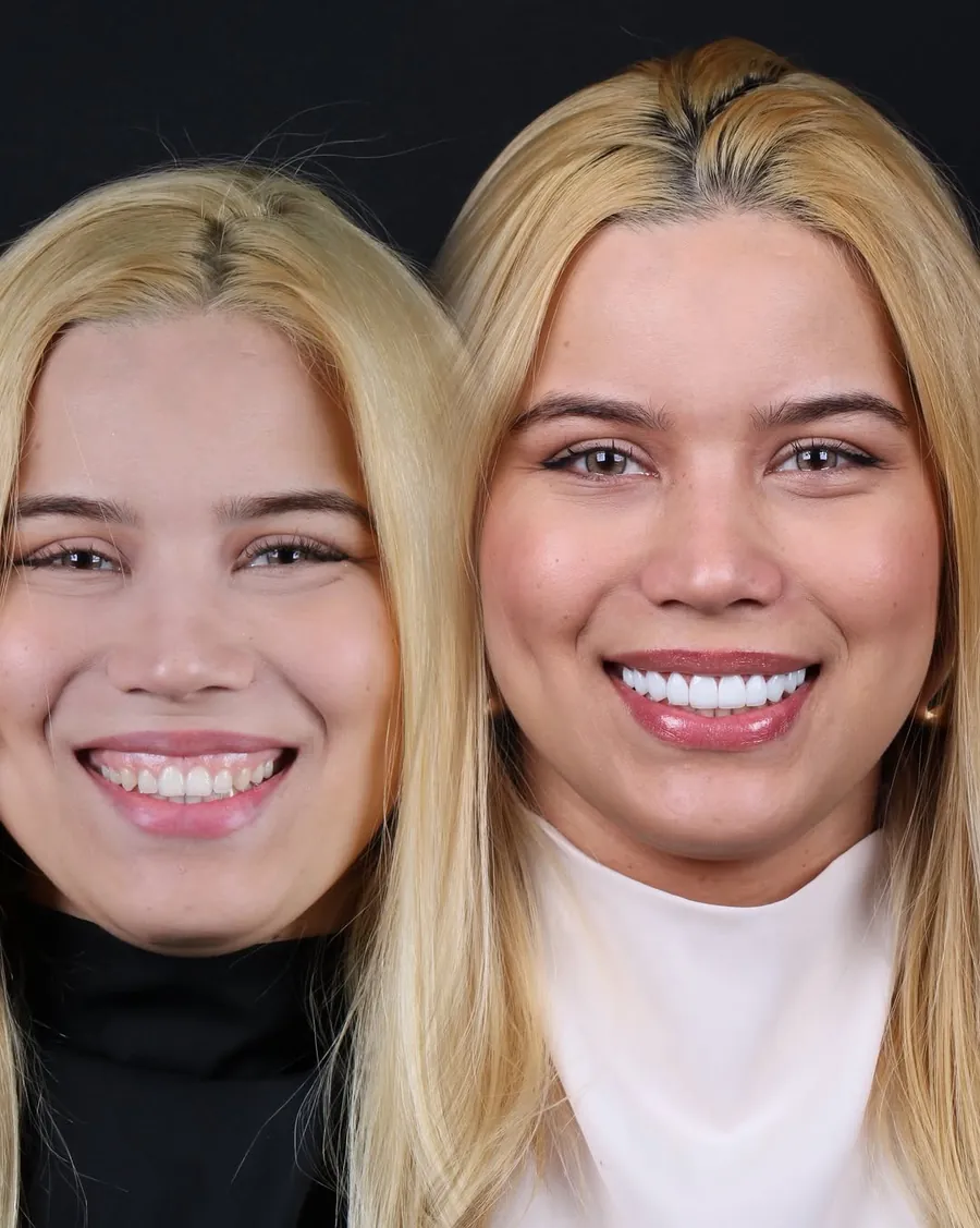 Antes e depois de gengivoplastia com lentes de resina