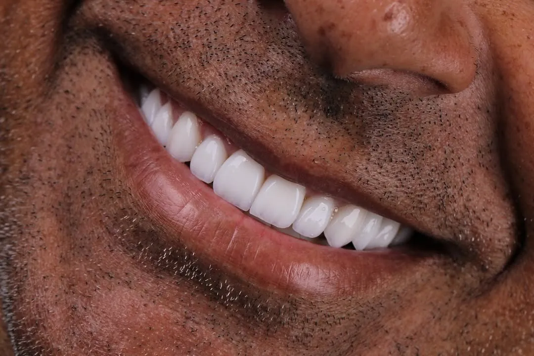 Detalhe de lentes de contato dental
