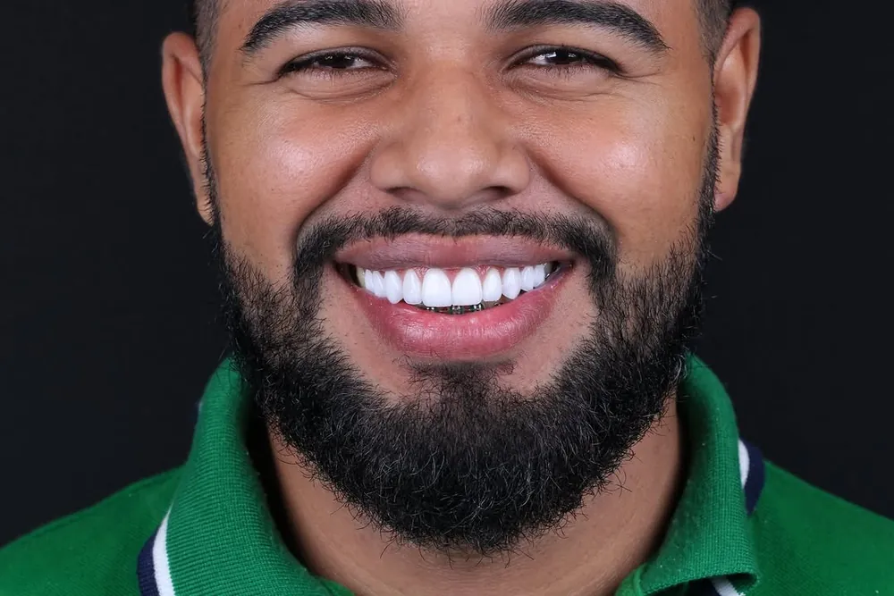 Paciente sorrindo com lentes de contato dental